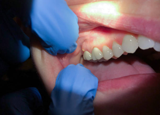Best Emergency Broken Tooth Repair in Lake Pocotopaug, CT